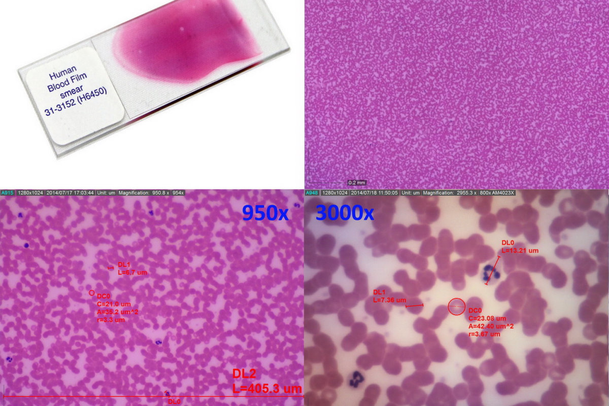 Blood Cells with Dino-Lite Handheld and Eyepiece Cameras